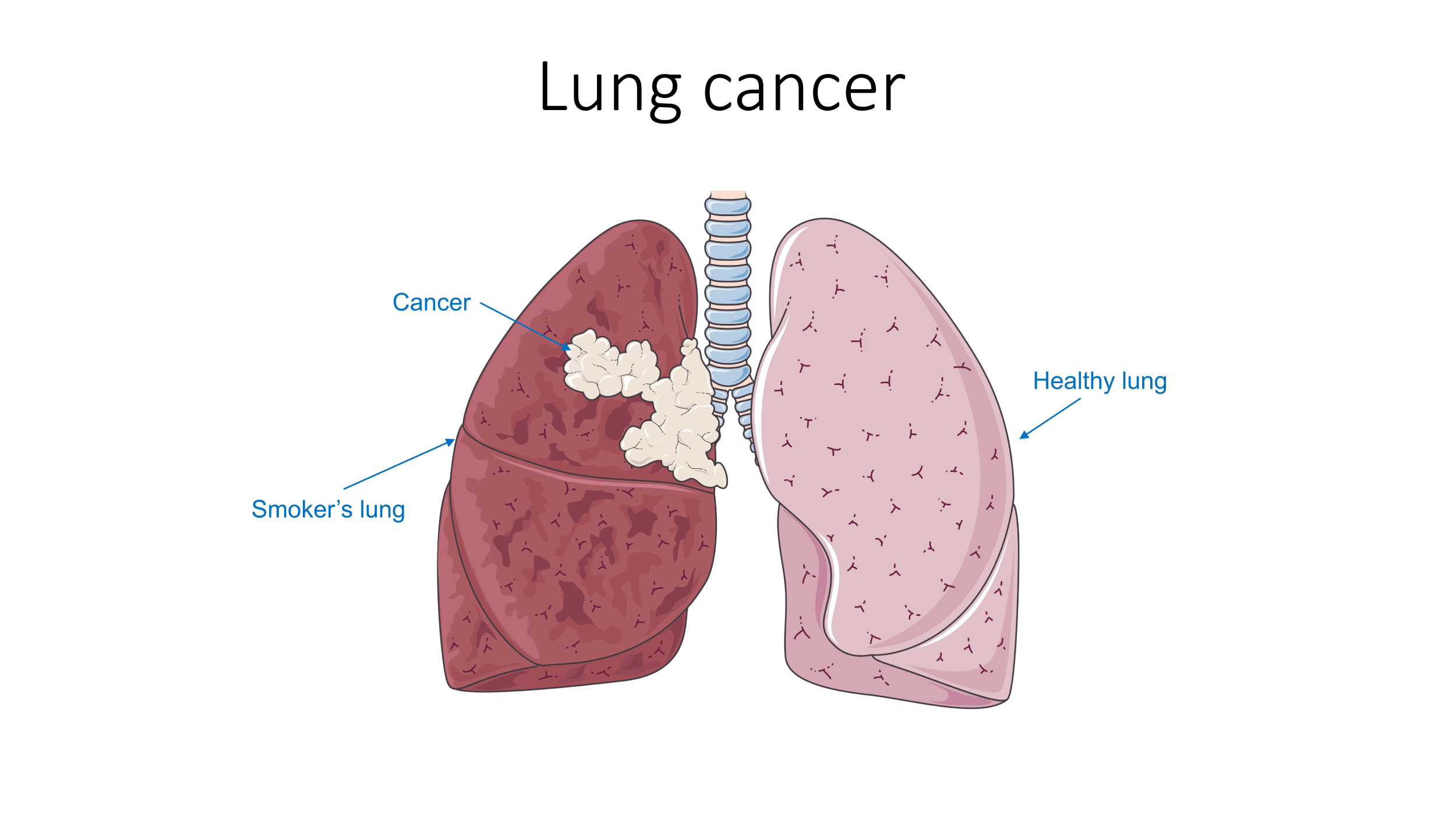 Lung Cancer Awareness Month: Why Early Detection Can Save Lives