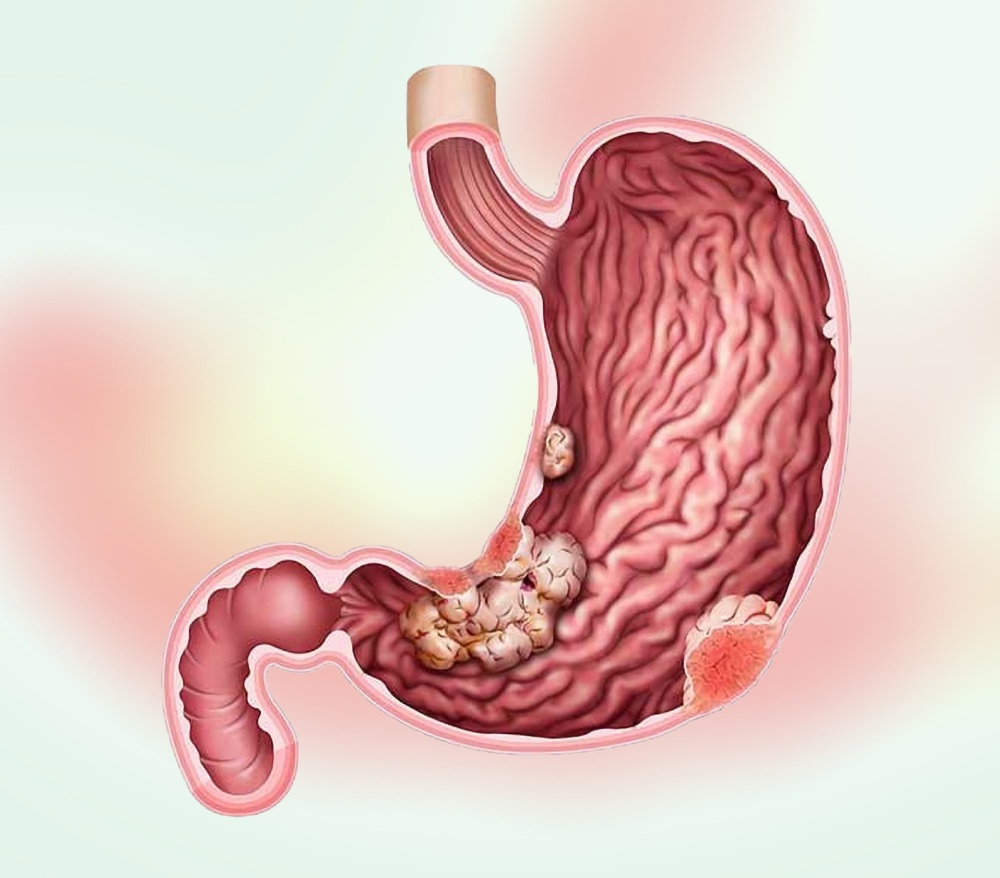 How Stomach Cancer Is Diagnosed: Endoscopy, Imaging, and Biopsy Explained